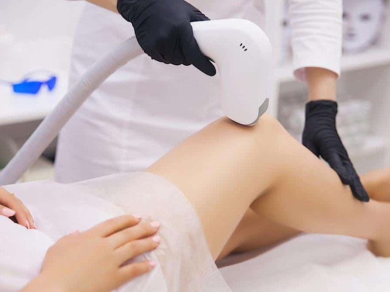 آیا لیزر موهای زائد باعث کیست میشود؟
