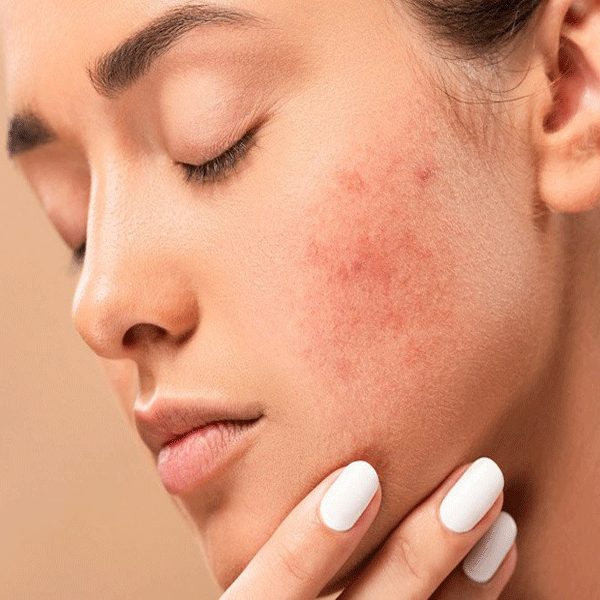 جوان سازی پوست جای جوش در اصفهان