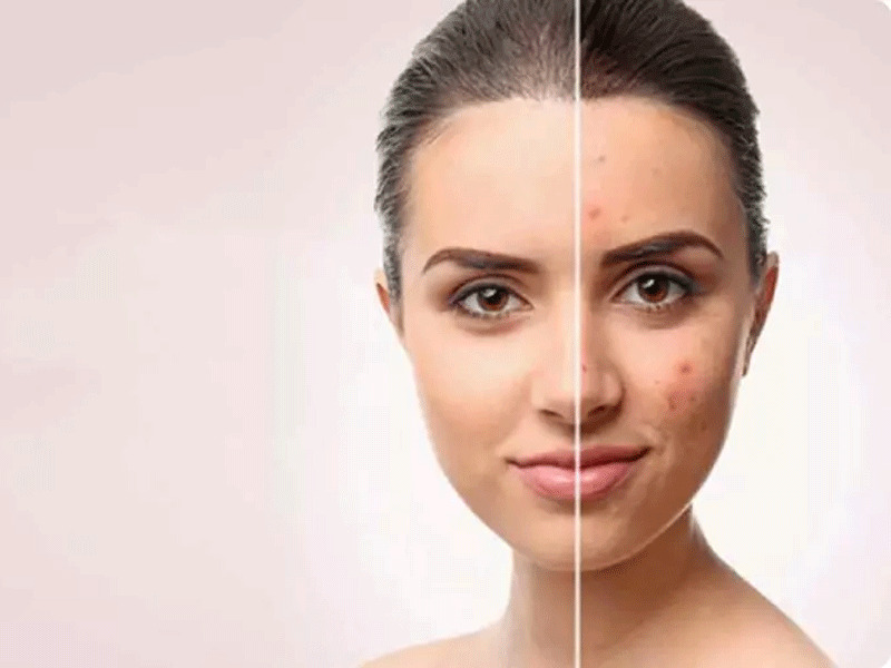 روش های جوان سازی پوست جای جوش در اصفهان