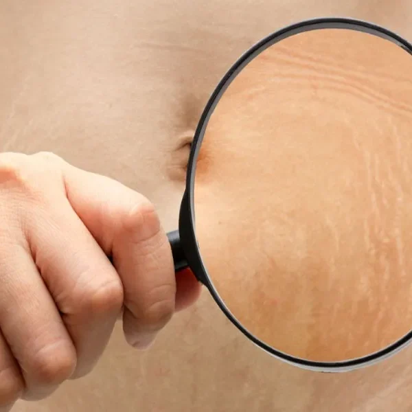 میکرو‌نیدلینگ برای ترک پوستی