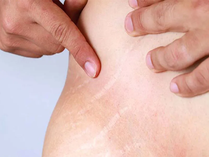 مزایای میکرونیدلینگ برای ترک پوستی