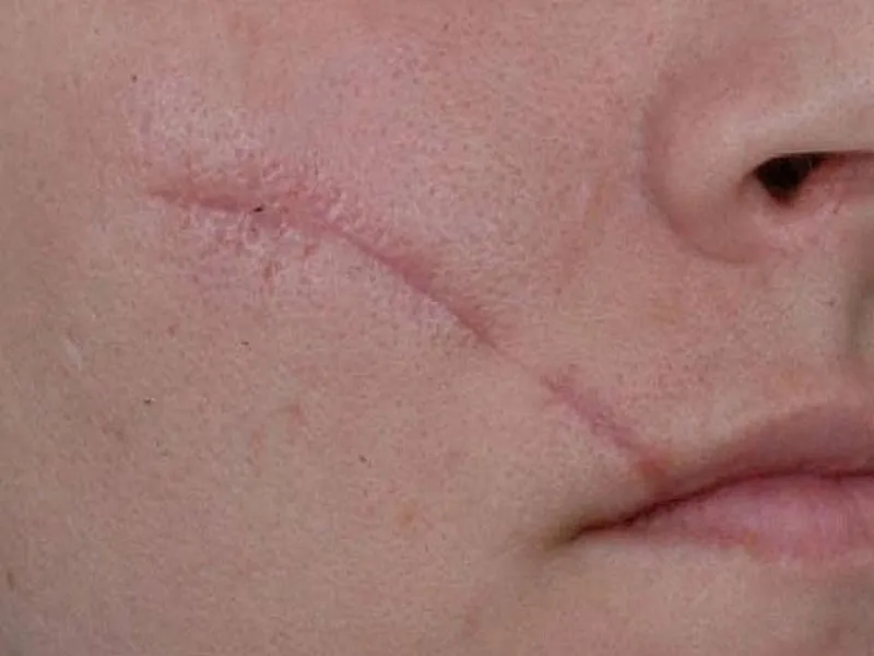 مزایای میکرونیدلینگ برای جای بخیه