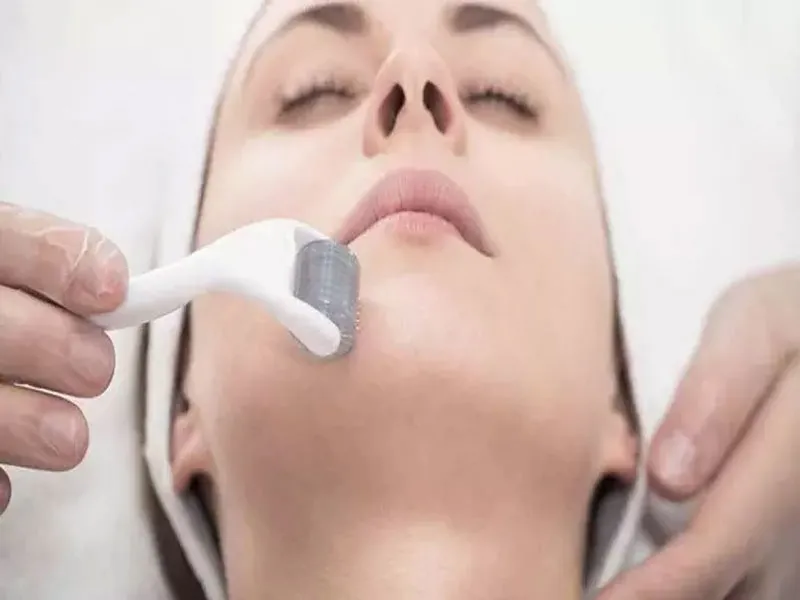 مزایای میکرو‌نیدلینگ برای منافذ باز پوست