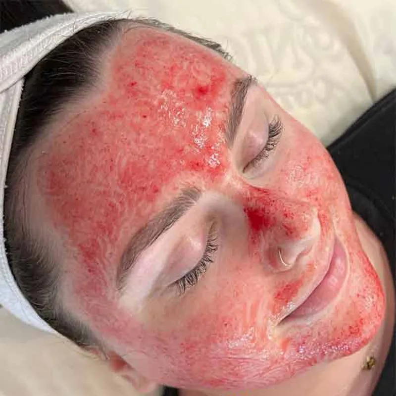میکرونیدلینگ برای پوست حساس