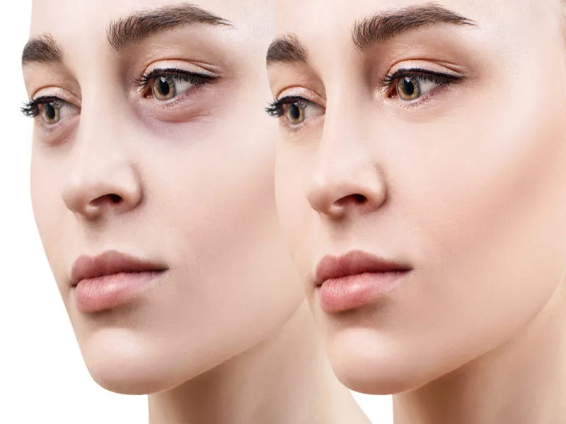 نتایج میکرو‌نیدلینگ برای گودی زیر چشم