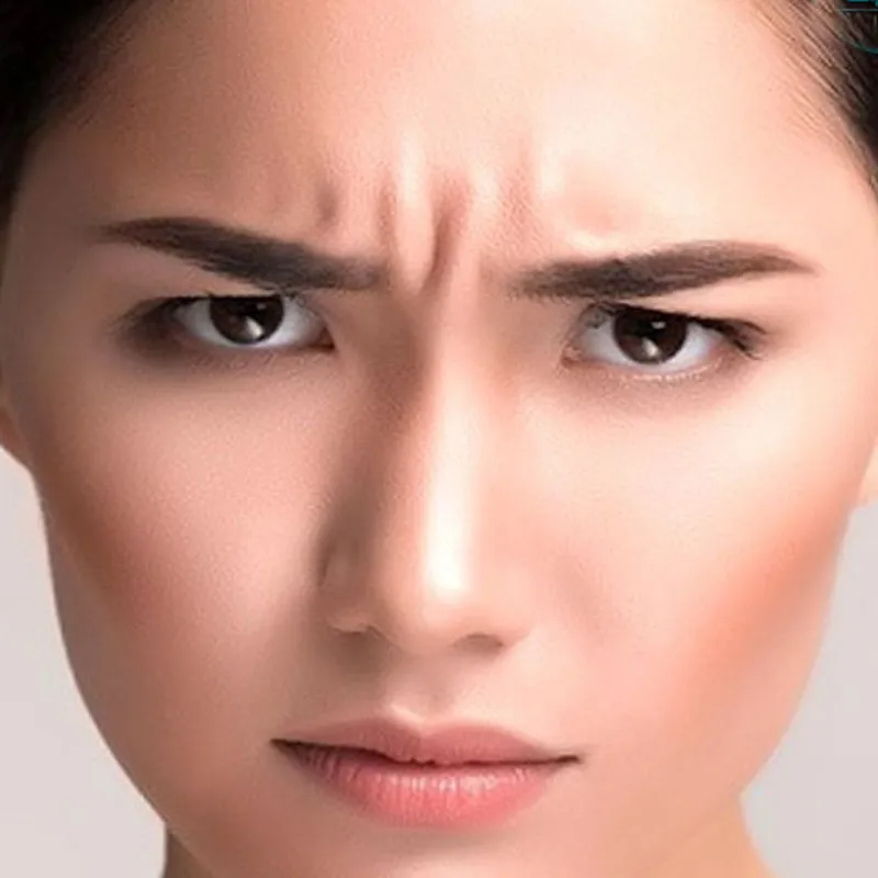 میکرونیدلینگ خط اخم