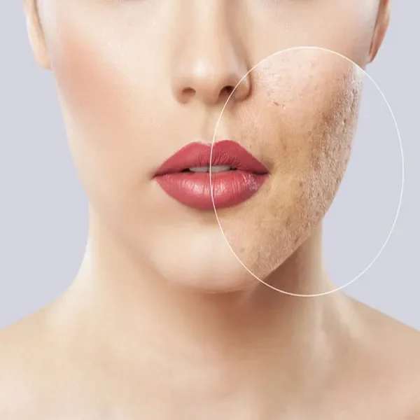 میکرو‌نیدلینگ صورت برای لک