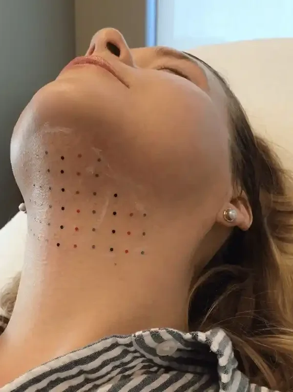 مزو‌تراپی غبغب در اصفهان