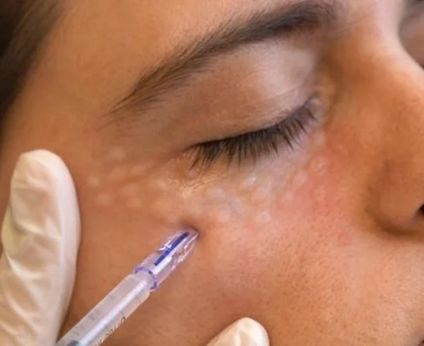 مزوتراپی زیر چشم چند جلسه است؟