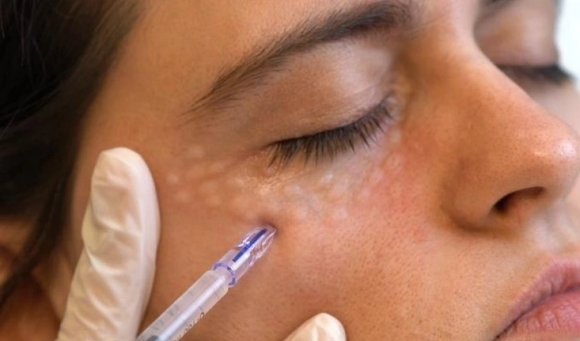 مزوتراپی زیر چشم چند جلسه است؟
