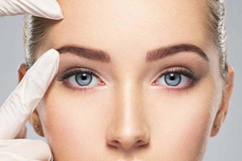نخ لیفت شقیقه در اصفهان