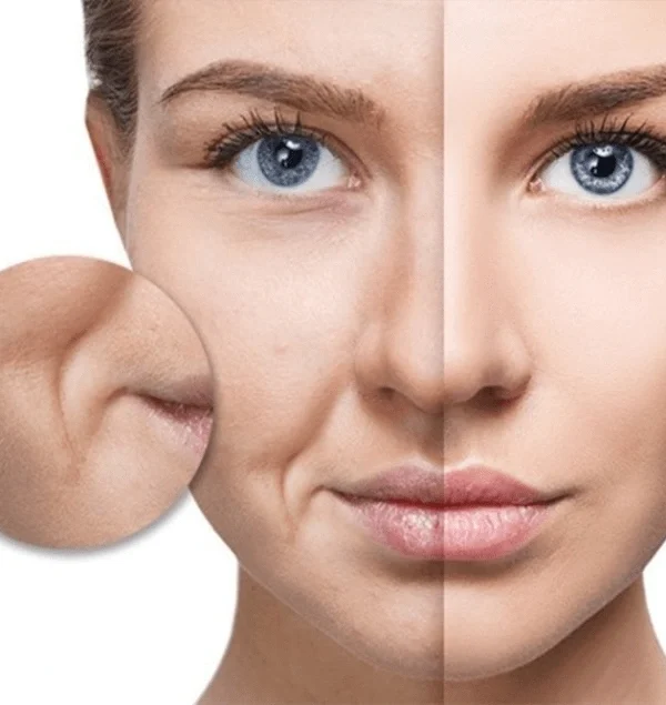لیفت با نخ برای خط خنده در اصفهان