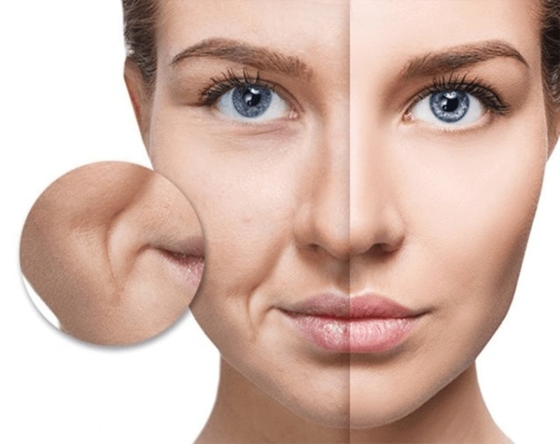 لیفت با نخ برای خط خنده در اصفهان
