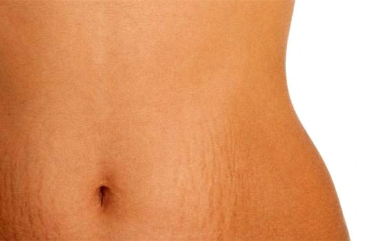 مزوتراپی ترک پوستی در اصفهان