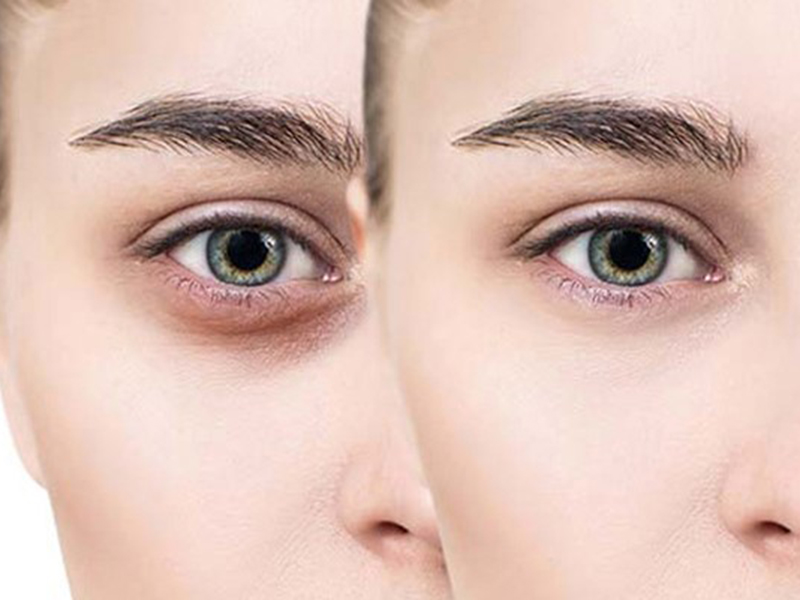 لیزر وایتنینگ زیر چشم