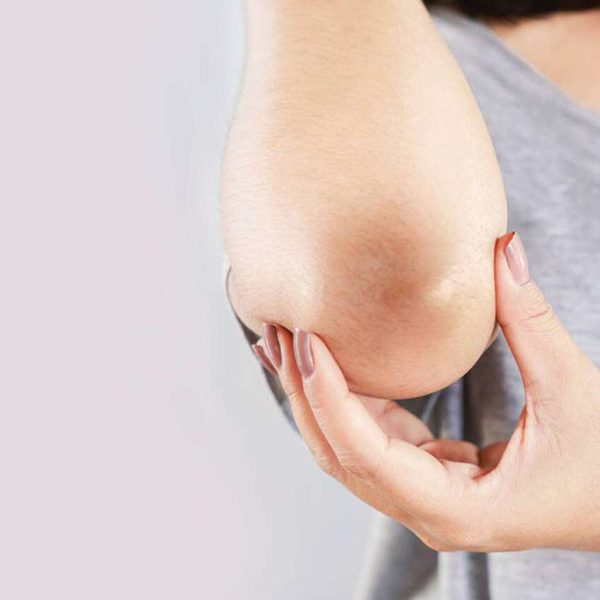 کربن تراپی آرنج
