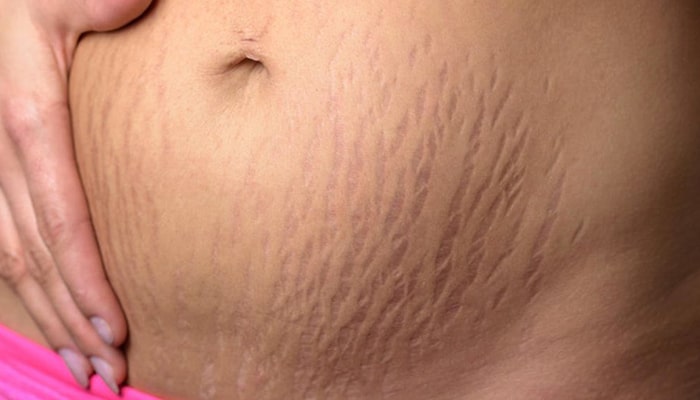 استرچ مارک شکم اصفهان