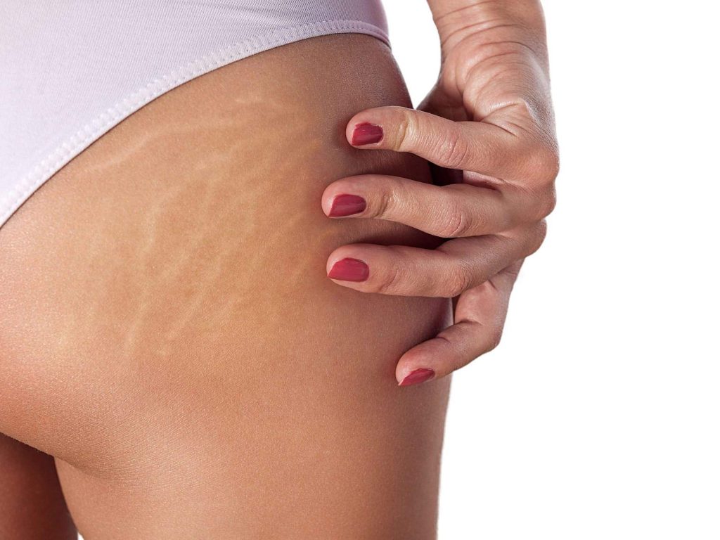 رفع استرچ مارک باسن اصفهان