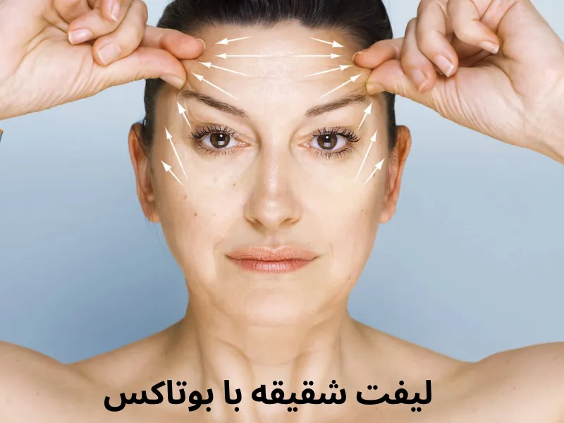 تزریق بوتاکس شقیقه